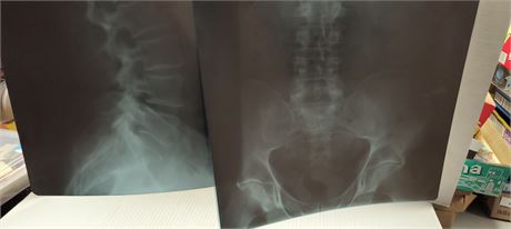 Vintage Spinal X-Ray Films